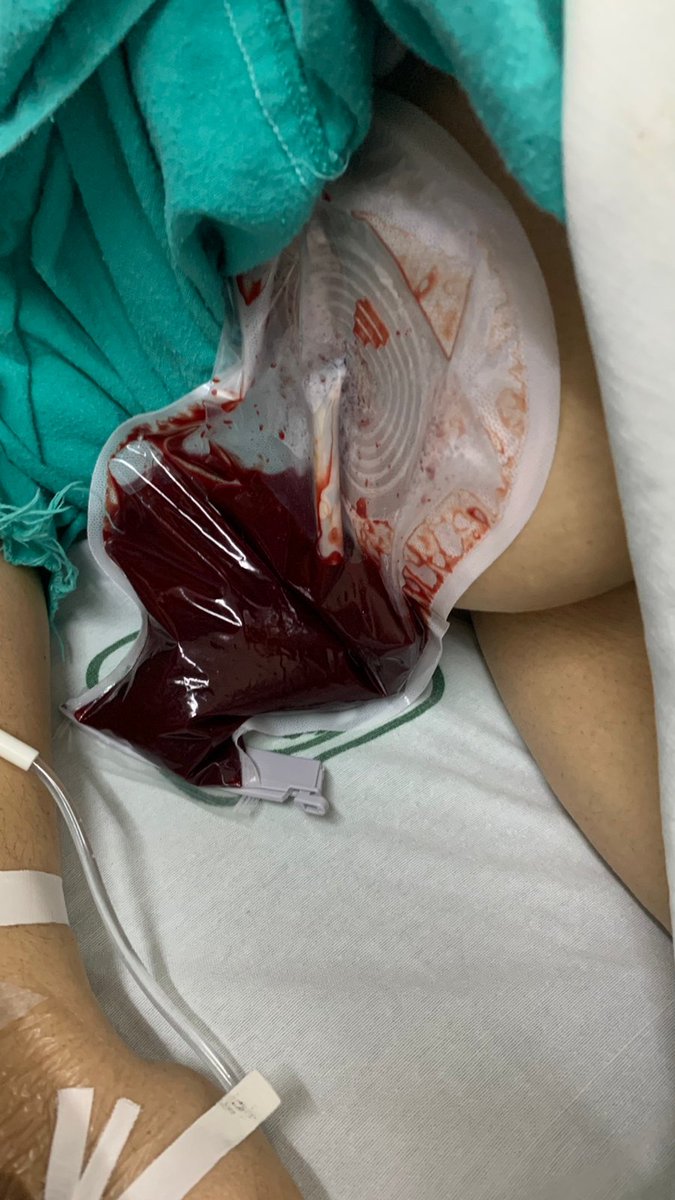 la sangre cuando viene de cavidad se activan los factores de coagulacion y no se forman coagulos en la bolsa colectora
si se forman coagulos viene d pared
en ambos casos
si es abundante igual causa estado de choque venga d donde venga