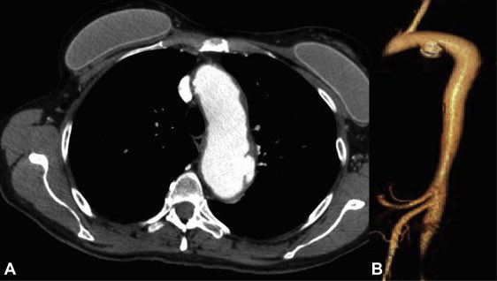 Normal aorta or abnormal?  Diagnostic possibilities?  #meded #MedTwitter #vascular #vascsurgery #surgery #radtwitter (source: J Vasc Surg)