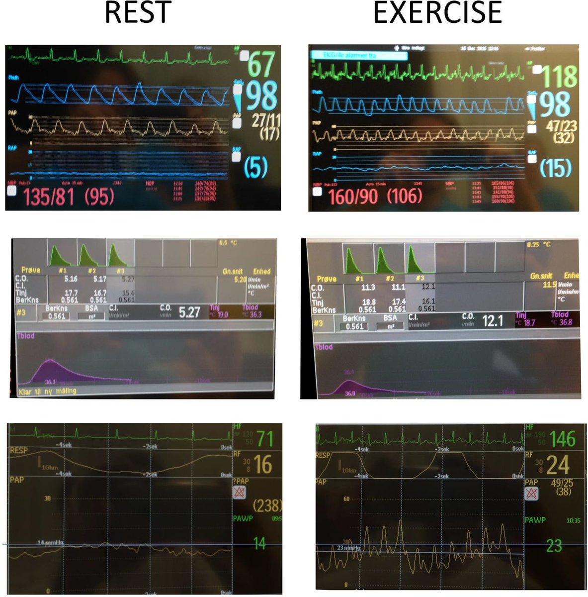 Heart_BMJ (@heart_bmj) on Twitter photo Pressure–flow responses to exercise in aortic stenosis, mitral regurgitation and diastolic dysfunction
heart.bmj.com/content/early/… Pressure–flow responses to exercise in aortic stenosis, mitral regurgitation and diastolic dysfunction
heart.bmj.com/content/early/…