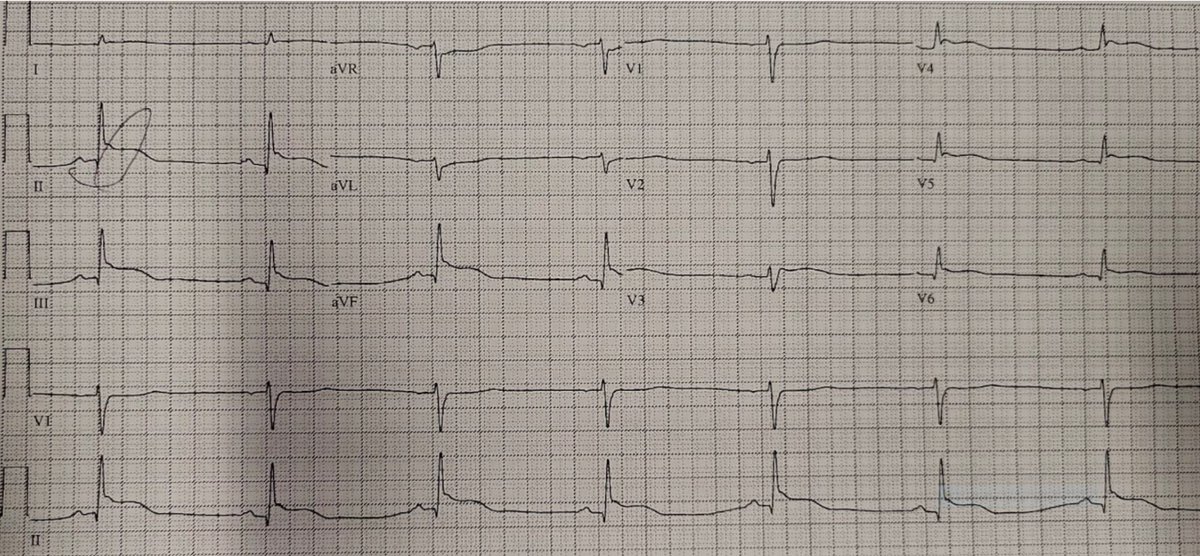 Stephen W. Smith (@smithecgblog) on Twitter photo Unconscious + STEMI criteria: activate the cath lab? <a href="/ECGcases/">Jesse McLaren</a>
hqmeded-ecg.blogspot.com/2023/01/uncons… Unconscious + STEMI criteria: activate the cath lab? <a href="/ECGcases/">Jesse McLaren</a>
hqmeded-ecg.blogspot.com/2023/01/uncons…