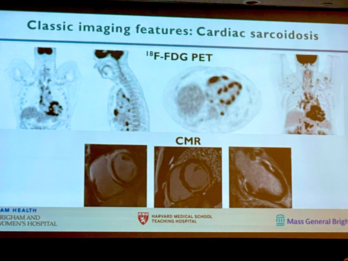 AnnaKateBarton's tweet image. #Multimodalityimaging in 🫀 Sarcoidosis
#Advances36

🔘LGE=inflammation OR scar and Rx is different for each state 
🔘 FDG PET: assess/extra cardiac inflammation BUT intense dietary prep
🔘FDG=prognostic implications
🔘Novel SPECIFIC inflammation tracers are coming (DOTATATE/FLT)