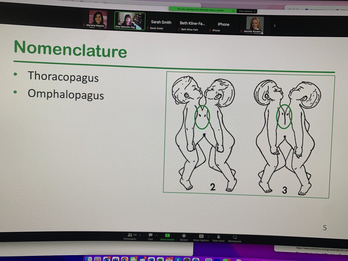 Mariana Meyers (@marianazmeyers) on Twitter photo <a href="/AmyMehollinRay/">Amy Mehollin-Ray, MD</a> just taught us at the #SPRFetal2023 course that in the thoracopagus conjoint twins, the abdomen will always be fused! <a href="/AmyMehollinRay/">Amy Mehollin-Ray, MD</a> just taught us at the #SPRFetal2023 course that in the thoracopagus conjoint twins, the abdomen will always be fused!