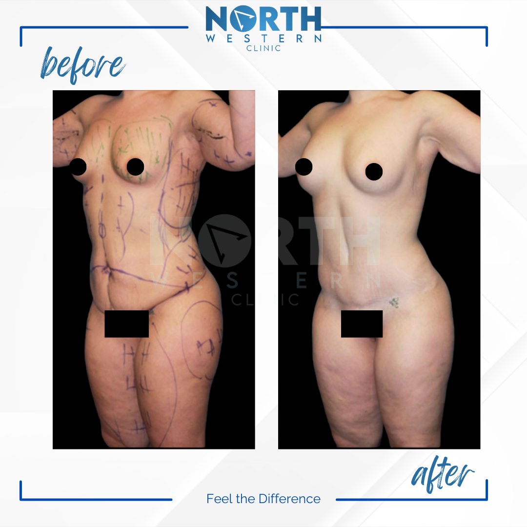 NorthWesternTR's tweet photo. Under anesthesia, you can combine your liposuction, tummy tuck, and BBL surgeries. Apply to us to avoid paying a fortune for relatively lower-quality surgery in the USA, Canada, or UK. You're always welcome here. #BBL #plasticsurgery #plasticsurgeryturkey #tummytuck #liposuction https://t.co/U8vn3pyqxC