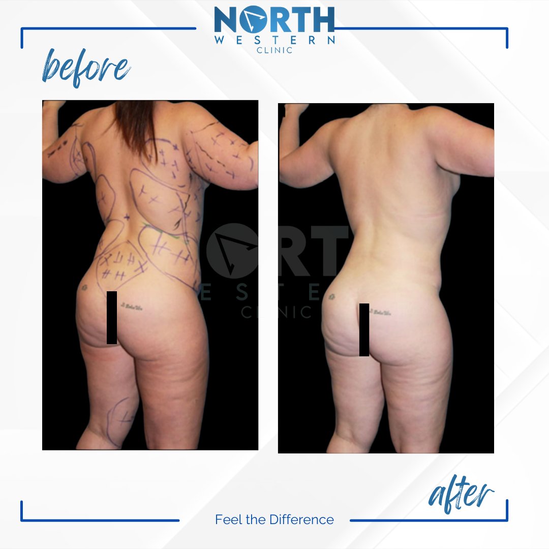 NorthWesternTR's tweet photo. Under anesthesia, you can combine your liposuction, tummy tuck, and BBL surgeries. Apply to us to avoid paying a fortune for relatively lower-quality surgery in the USA, Canada, or UK. You're always welcome here. #BBL #plasticsurgery #plasticsurgeryturkey #tummytuck #liposuction https://t.co/U8vn3pyqxC