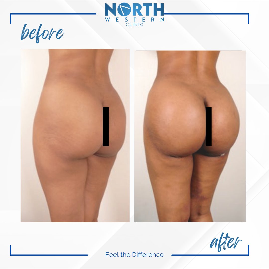 NorthWesternTR's tweet photo. You can enhance your self confidence with your BBL surgery. It can be easier than you think. #bbl #plasticsurgery #plasticsurgeon https://t.co/FVqRW3J777