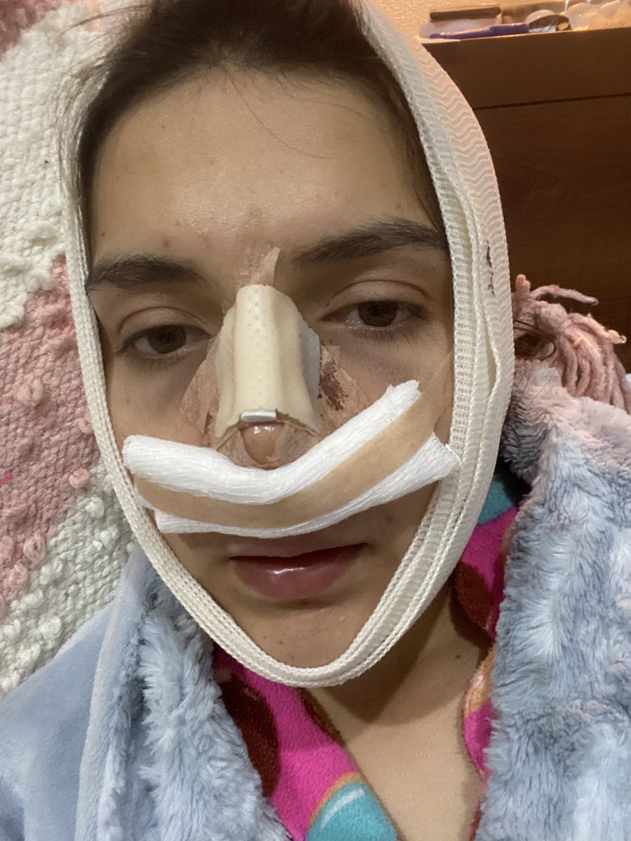 mon_caballero_'s tweet photo. How it started vs how it’s going ❤️🩹
#rinoplastia + #Lipopapada https://t.co/iEK4T3B8WF