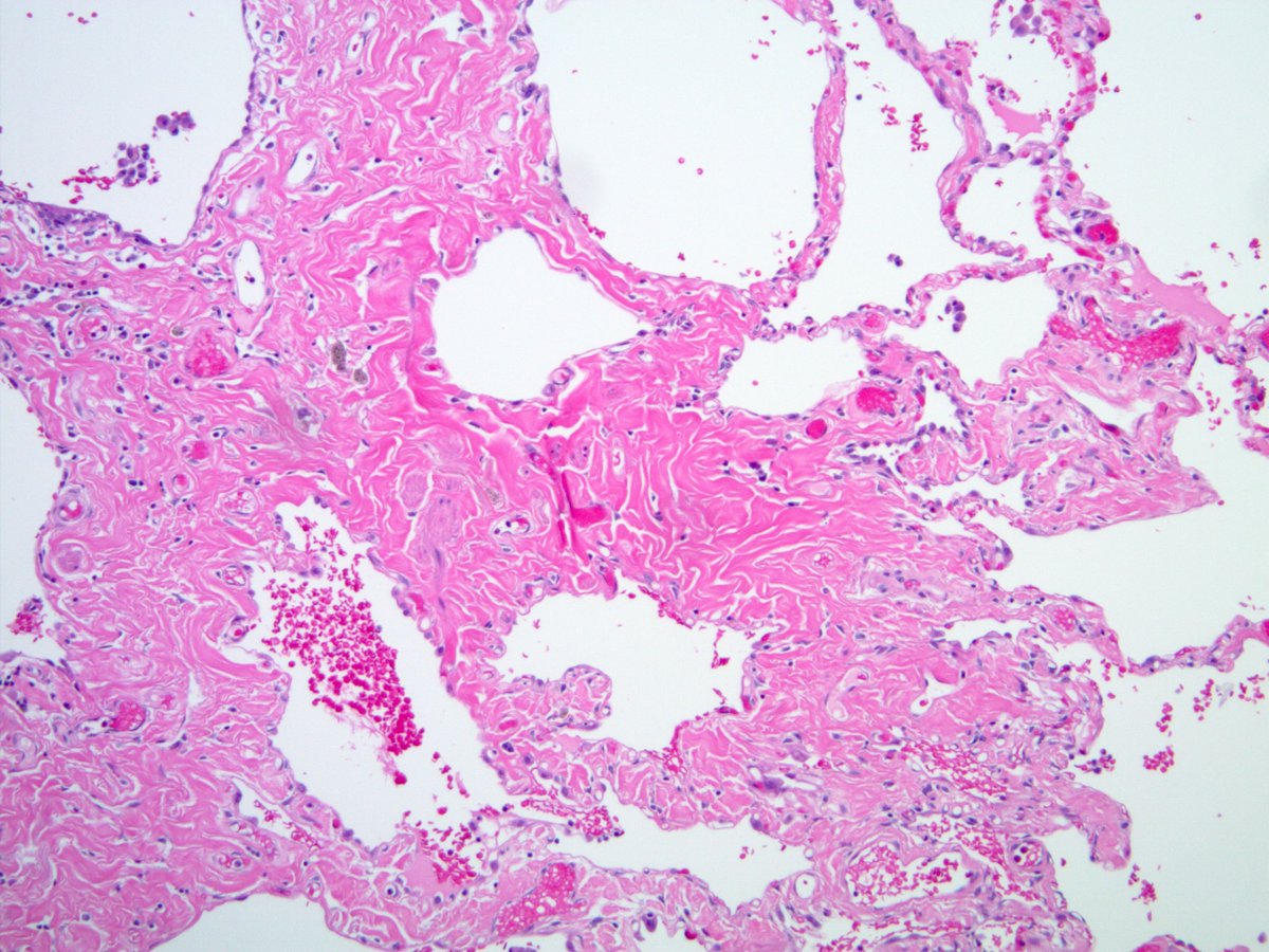 Game changer: #SRIFSunday pubmed.ncbi.nlm.nih.gov/36495281/ Smoking-related interstitial fibrosis (SRIF) is a game changer. A paradigm shift. Why? Because its recognition allows pathologists... kikoxp.com/posts/19977