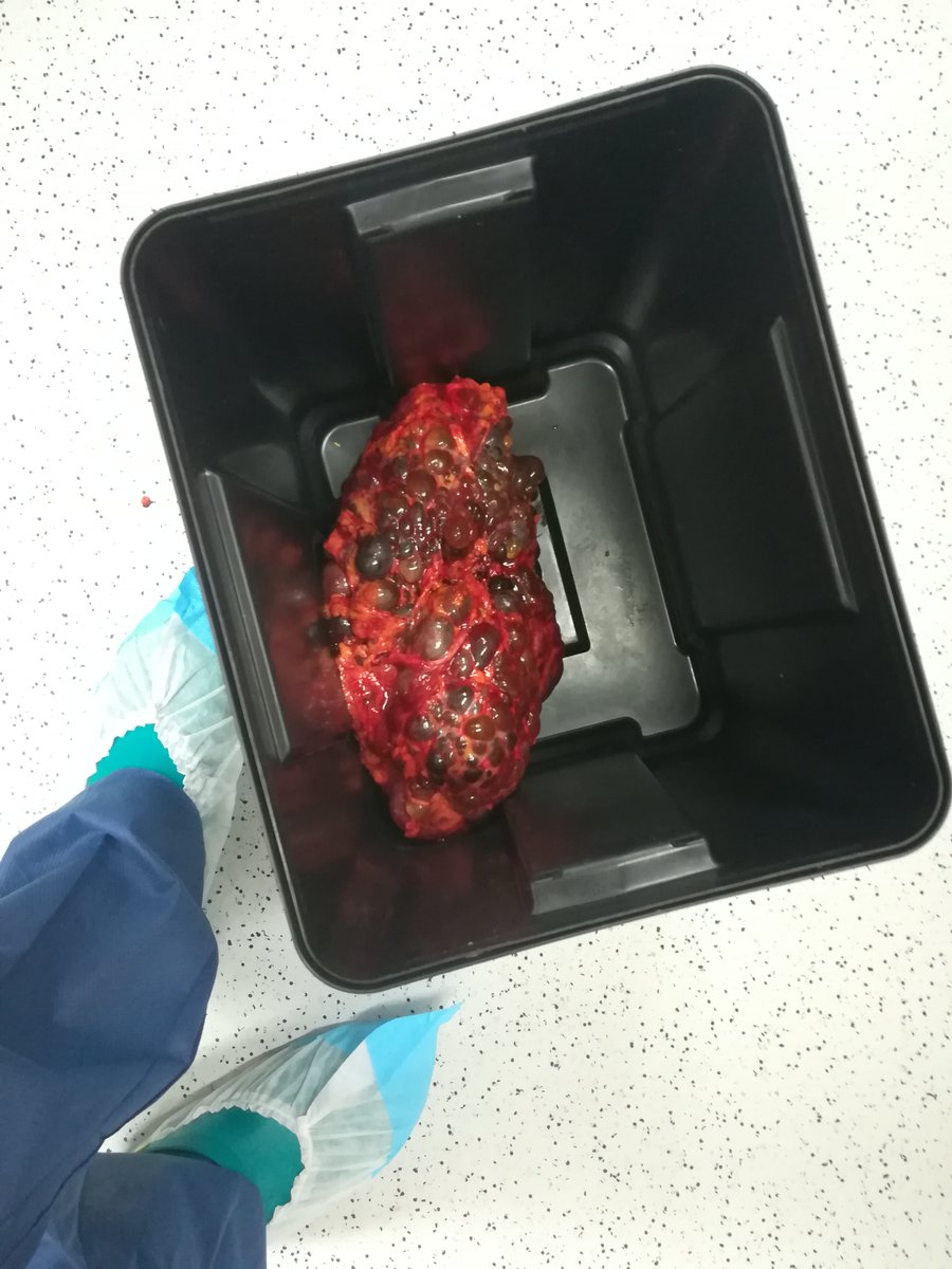ADPKD is the most common hereditary kidney disease and one of the most common causes of end-stage kidney disease. 

Here a polycystic kidney, look at the size compared to my foot (45 EU, 10 UK, 11 US)!!
#urology #nefrology #kidney #surgery #recidency
#eau #urologia
