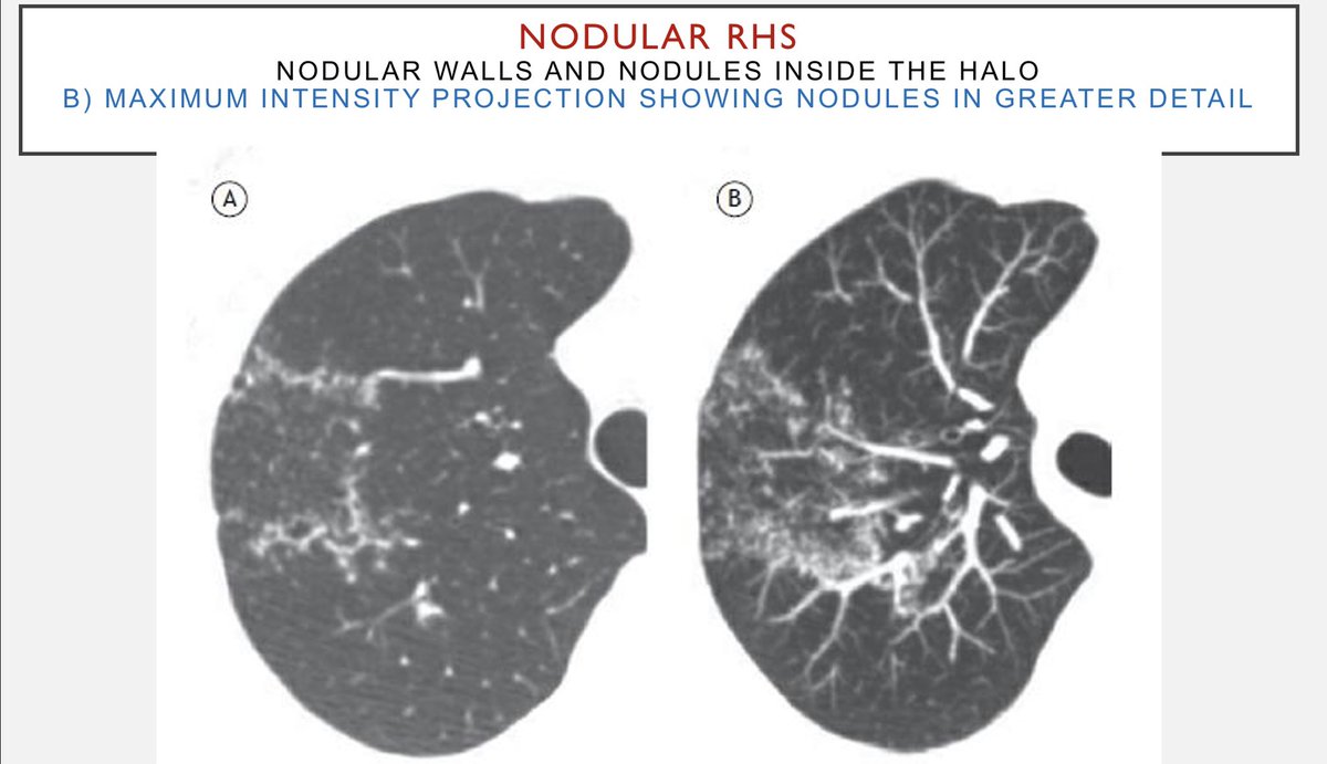 Dr Khaled Ahmed Abuzeid on Twitter "Nodular RHS is atypical feature of