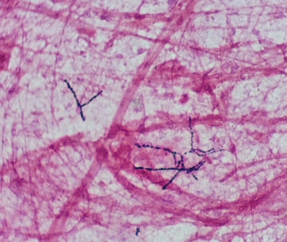 microRyC's tweet photo. Microbiología de guardia 📞

Llamada por varón 55 años ex-UDVP, VIH (biktarvy) y EPOC III que acude por disnea tras dx hace 10 días de Gripe A. En rx de tórax: neumonía bilateral. 

Nos solicitan Gram de esputo 📸donde se observan bacilos+ ramificados en ángulo de 90.

Dx? Tto? https://t.co/Z71bvoTCto