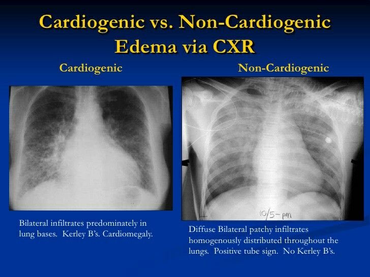 toroalejandr's tweet photo. @BrownHospMed @EMGuideWire @LITFLblog Naloxone-induced noncardiogenic pulmonary edema: rare but reported entity that can occur following naloxone use in the reversal of opioid overdose. Appears to be more common when higher doses of naloxone are used. Catecholamine surge → adrenergic crisis → shift in volume → NPE https://t.co/6QvtqEf0zg
