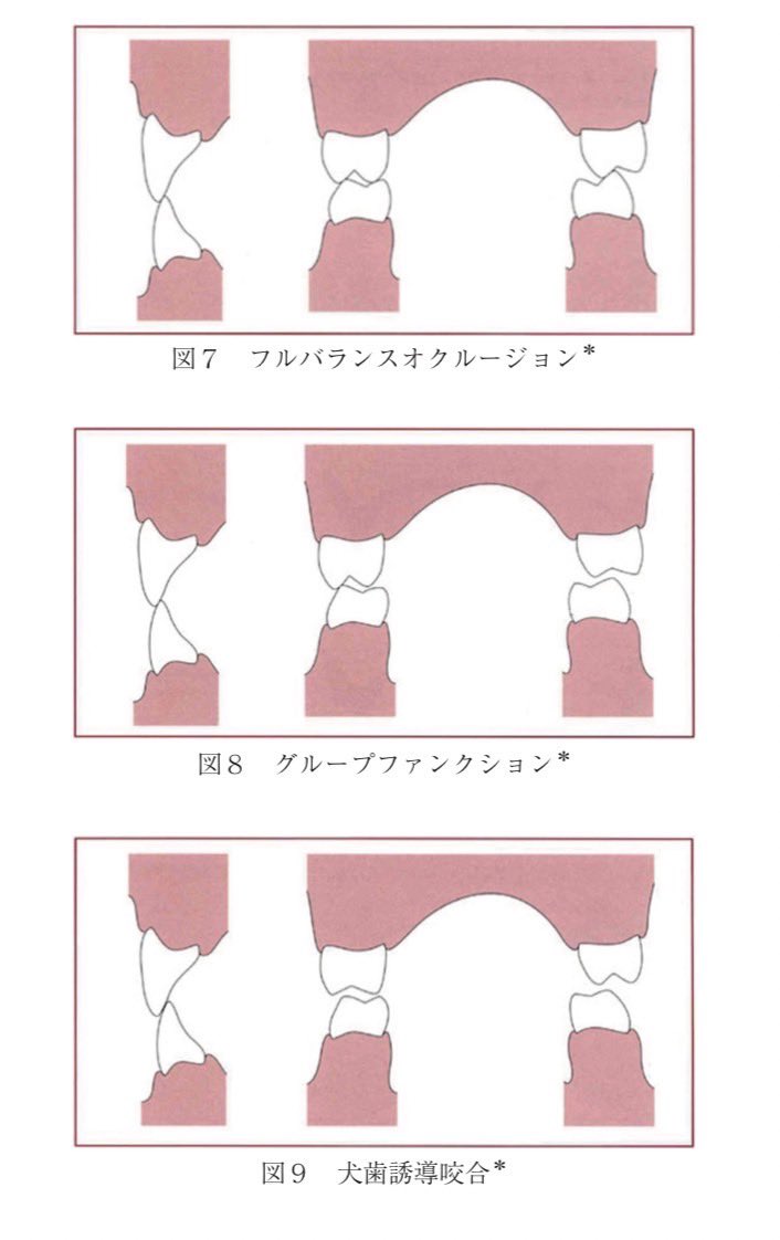 ️📝️️メモ ○フルバランスオクルージョン(平衡咬合) ・フル=全部