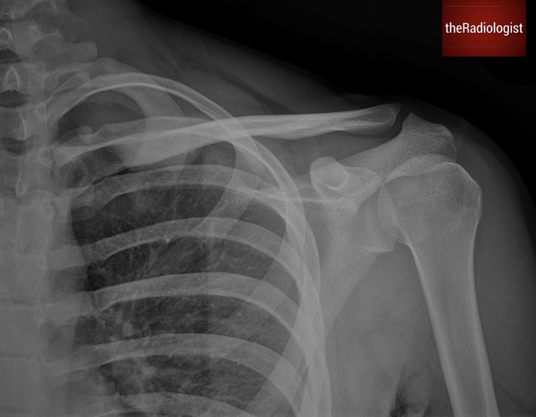 Male aged 20 presents after trauma. What does the X-Ray show?
