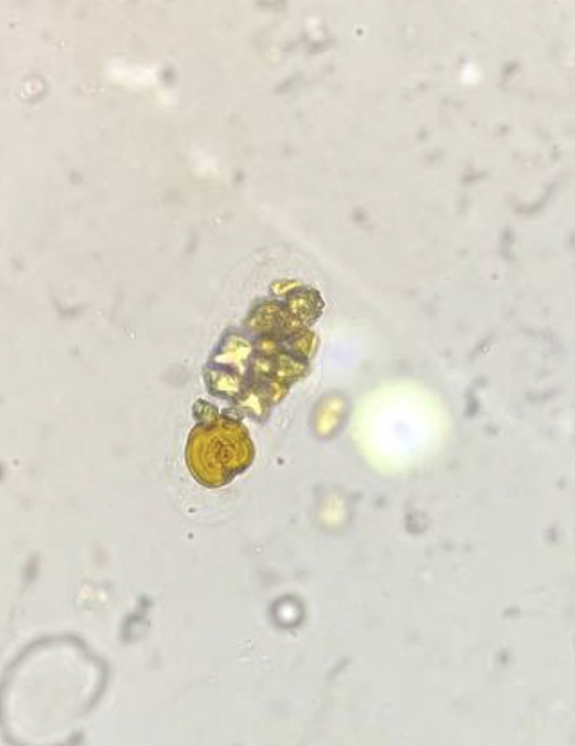 Mixed celular Cast, with Leucine and Calcium Oxalate Crystals -brightfield, hepatorenal syndrome.#UrinarySediment #UrineMicroscopy ⁦<a href="/VelezNephHepato/">Juan Carlos Q Velez</a>⁩ ⁦<a href="/jrseltzer/">Jay R. Seltzer</a>⁩