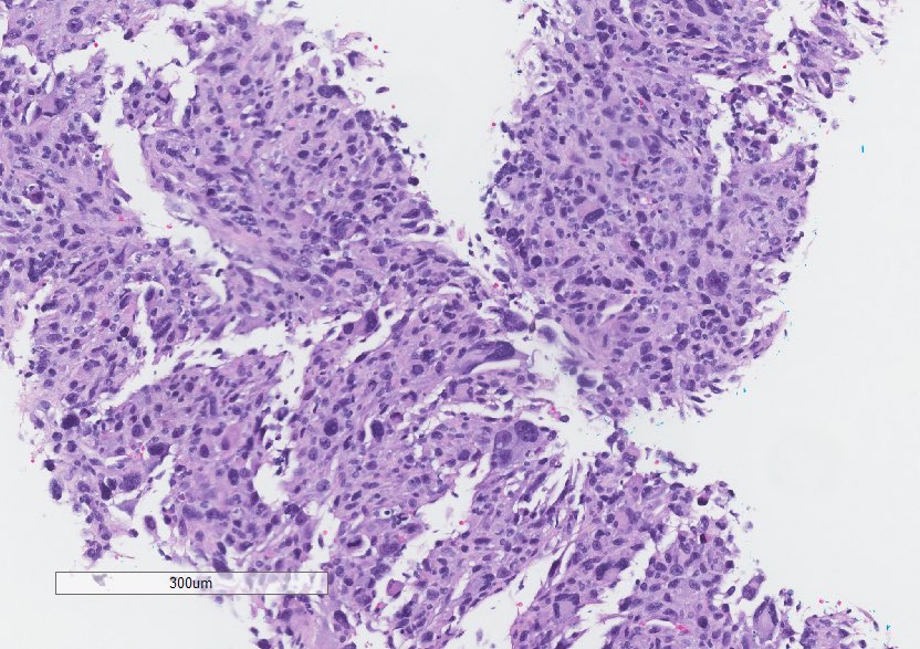 Pancreatic mass. #PathTwitter #GIpath