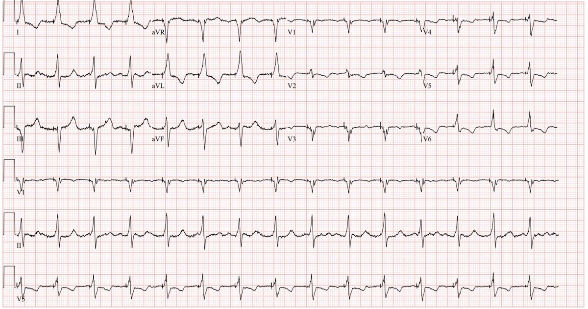 AV node ablation

#EPeeps #dontdisthehis #conductionsystempacing #LBBpacing