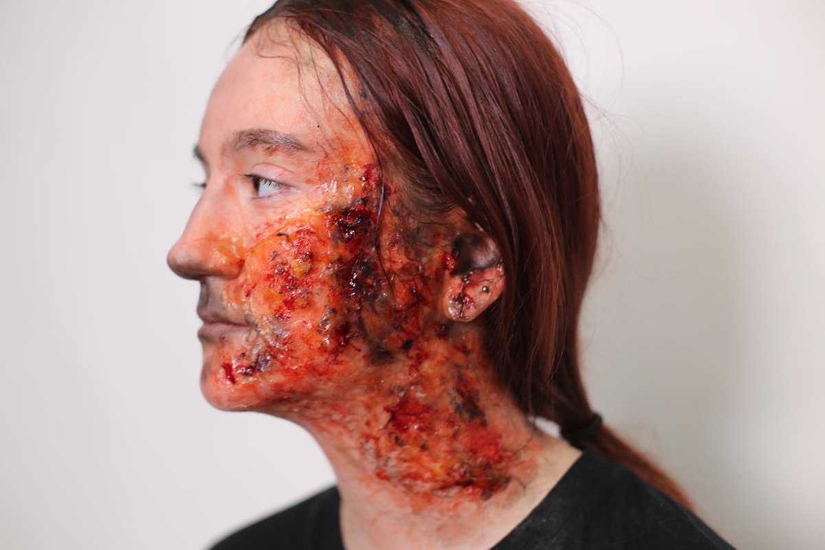 Some of my burn special effects :) 
#filmmakeup #specialeffetsmakeup #sfx