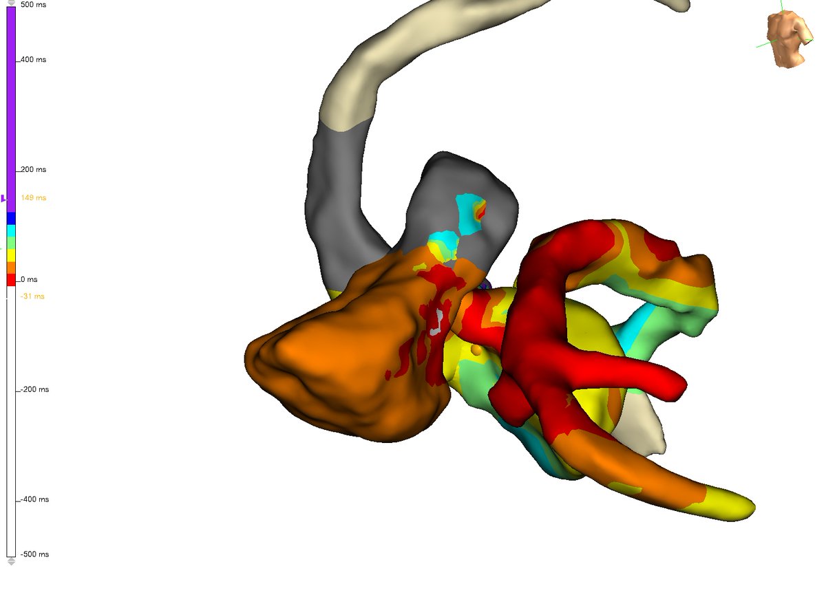 andres_miranda4's tweet photo. Bipolar ablation for intramural PVC. An alternative apprch when the sweet spot is beneath the surface
75y.o. M. h/o CABG. New onset HFrEF 30%, monomorphic PVC  with 33% burden. Prev failed ablation from septal RVOT. Great case @andresenriqueza.
@adribaran @JorgeERomeroMD @utedrow https://t.co/EHC8fOxMQb