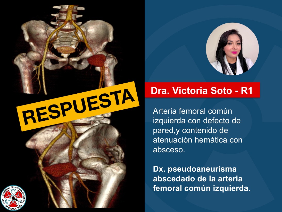 A continuación la respuesta del caso de esta semana. ¡Excelente Viernes!
#CT #FOAMed #radres