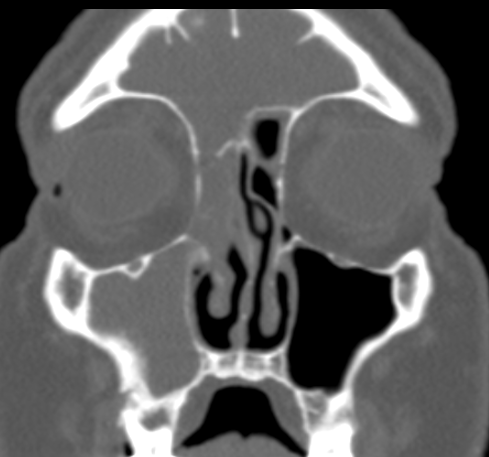 DrScottFortune's tweet photo. This longstanding case of #odontogenicsinusitis looked like #IP at surgery #FrozenSection was negative for Inverting Papilloma and final path was chronic inflammation This is #PapillaryInflammation of #ODS @JohnCraigNose @ent_ams @WarrenMullings #Rhinology https://t.co/jxxPWF09jC