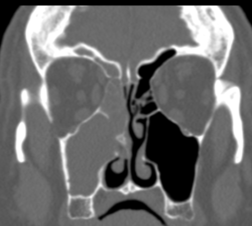 DrScottFortune's tweet photo. This longstanding case of #odontogenicsinusitis looked like #IP at surgery #FrozenSection was negative for Inverting Papilloma and final path was chronic inflammation This is #PapillaryInflammation of #ODS @JohnCraigNose @ent_ams @WarrenMullings #Rhinology https://t.co/jxxPWF09jC