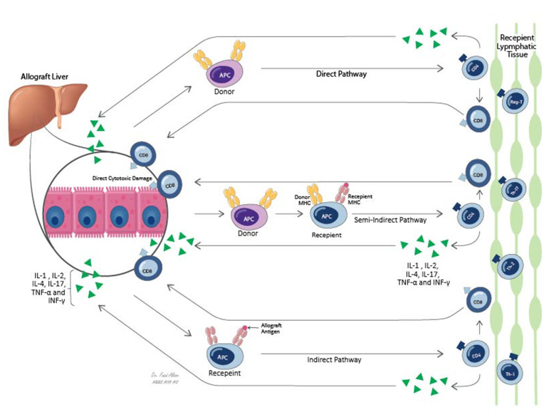 Fuad Aloor (@fuadzain_medart) on Twitter photo Happy to be part of this work. The figure below was created to display the different pathways involved in the rejection and graft survival of liver transplant. Good collaborative effort <a href="/AhmedEl62908040/">Ahmed El Sabagh, MD</a> <a href="/drislambadr/">Islam B. Mohamed MD, MSc</a> <a href="/JalalPrasun/">Prasun. K Jalal</a> Happy to be part of this work. The figure below was created to display the different pathways involved in the rejection and graft survival of liver transplant. Good collaborative effort <a href="/AhmedEl62908040/">Ahmed El Sabagh, MD</a> <a href="/drislambadr/">Islam B. Mohamed MD, MSc</a> <a href="/JalalPrasun/">Prasun. K Jalal</a>