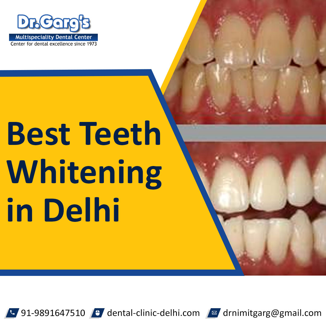 Trust it for being the #bestdentalclinic among the options you have for a #dentalcenterteethwhitening near me. 

🌐 bit.ly/Teeth-Whitenin…
📞 98916 47510 
WhatsApp on: wa.me/919891647510

#teethwhiteningnearme #teetwhiteningdentalcenter  #tbt #follow #MondayFeeling
