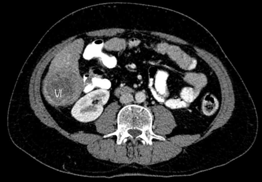 Hassaan Bari (@dr_hassaanbari) on Twitter photo Cirrhotic liver:To Pringle or not to Pringle? ⚖️:🩸vs. Ischemia
51👦, HepC, sg VI&VII HCC,🚫portal HTN
🔪:VI&VII NAR
IntraOp: no Pringle,🩸loss 1000mls!
Home: D4
Margins: -ve
WWYD about Pringle in NAR for cirrhotic?
<a href="/IHPBA/">IHPBA</a> <a href="/hpb_so/">SoMe4HPB</a> <a href="/SOS_Pk/">Surgical Oncology Society Pakistan. SOSPK</a> <a href="/HpbLounge/">HPB Lounge</a>
#MedTwitter #Cancer #MedEd Cirrhotic liver:To Pringle or not to Pringle? ⚖️:🩸vs. Ischemia
51👦, HepC, sg VI&VII HCC,🚫portal HTN
🔪:VI&VII NAR
IntraOp: no Pringle,🩸loss 1000mls!
Home: D4
Margins: -ve
WWYD about Pringle in NAR for cirrhotic?
<a href="/IHPBA/">IHPBA</a> <a href="/hpb_so/">SoMe4HPB</a> <a href="/SOS_Pk/">Surgical Oncology Society Pakistan. SOSPK</a> <a href="/HpbLounge/">HPB Lounge</a>
#MedTwitter #Cancer #MedEd