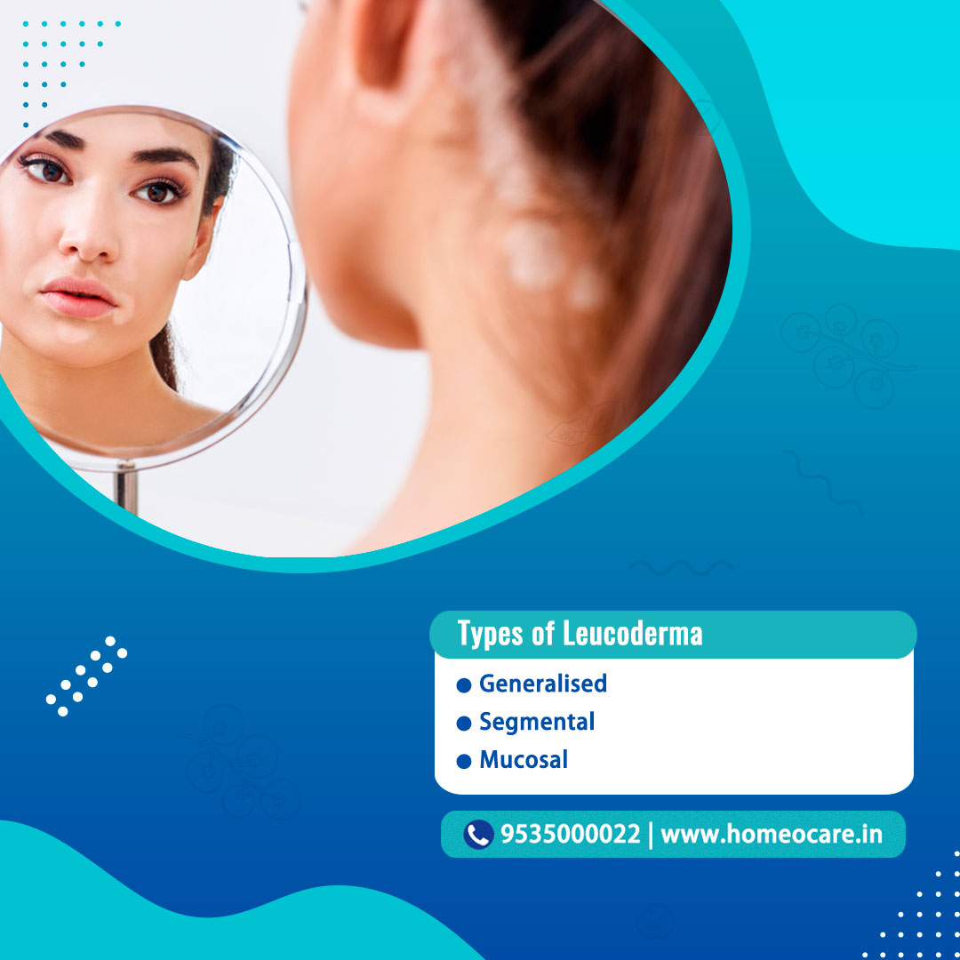 homeocareint's tweet image. 𝐓𝐲𝐩𝐞𝐬 𝐨𝐟 𝐋𝐞𝐮𝐜𝐨𝐝𝐞𝐫𝐦𝐚
●Generalised 
●Segmental
●Mucosal

Please 𝐜𝐚𝐥𝐥 𝟗𝟓𝟑𝟓𝟎𝟎𝟎𝟎𝟐𝟐 to get more information from our experts and to book your appointment.

#Leucoderma #TypesofLeucoderma