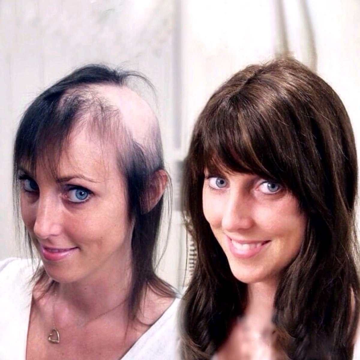 Elithair's tweet photo. ОБЛЫСЕНИЕ?
Мы поможем вам!

Суть метода безоперационного замещения естественных волос заключается в том, что из натуральных волос индивидуально создается новый волосяной покров, идеально подходящий по цвету, длине и структуре, который фиксируется на… https://t.co/t0v4niiBNq https://t.co/bu9PFCoL8j