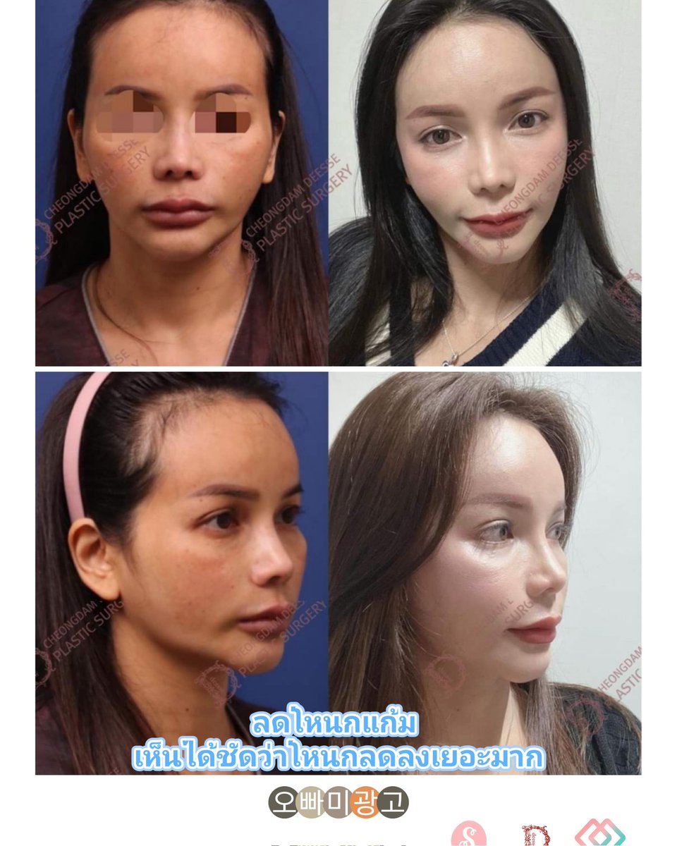 seoultrendna's tweet image. ลดโหนกแก้ม เห็นได้ชัดว่าโหนกลดลงเยอะมาก ไม่ว่าจะมุมหน้า หรือมุมข้าง

ปรึกษาศัลยกรรมฟรี📲
คลิกที่ลิ้งค์นี้ได้เลย👉lin.ee/rYdq3oy
สำนักงานใหญ่ G Tower Rama 9, Bangkok
#oppame #ที่ปรึกษาศัลยกรรมเกาหลี  #เอเจนซี่ที่ปรึกษาศัลยกรรมเกาหลี #เอเจนซี่ #ศัลยกรรม #오빠미광고