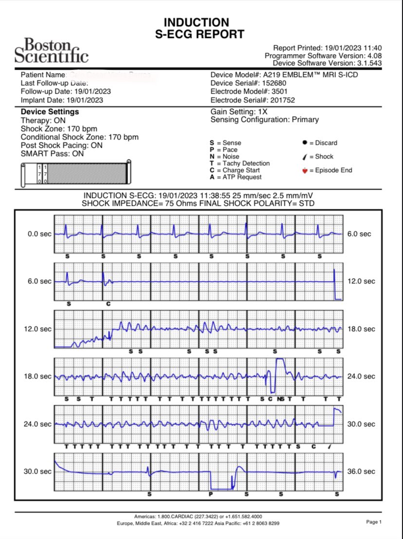educostacardiol's tweet photo. How deep does the brain go in VF induction by ICD? 🧠💙 #ventricularfibrillation #arrhythmia #SICD #EPeeps #suddendeath #brain #EEG #bismonitoring https://t.co/23AOgt3qDe