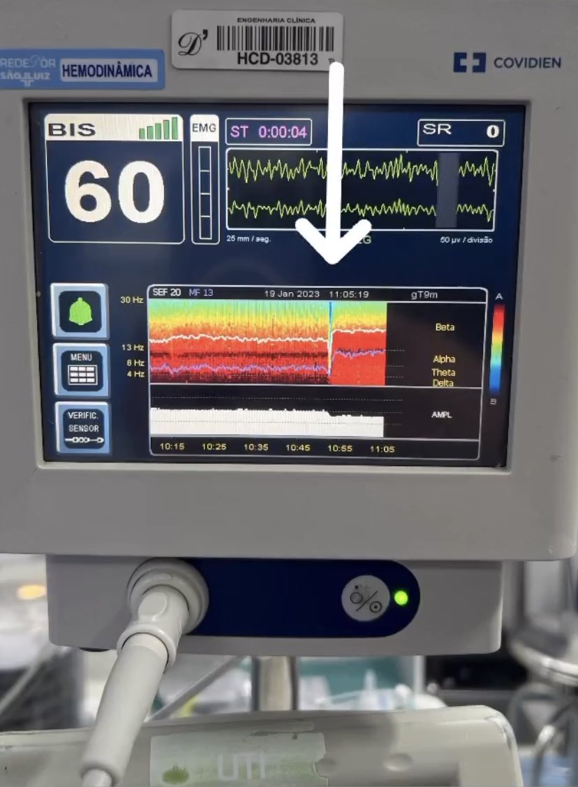 educostacardiol's tweet photo. How deep does the brain go in VF induction by ICD? 🧠💙 #ventricularfibrillation #arrhythmia #SICD #EPeeps #suddendeath #brain #EEG #bismonitoring https://t.co/23AOgt3qDe