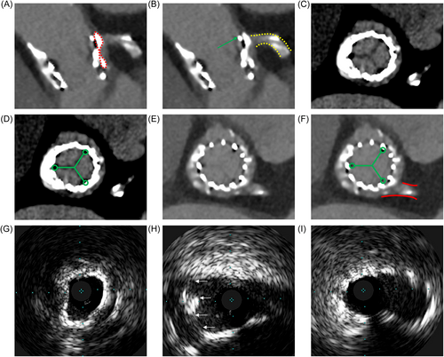 Giuseppe Biondi-Zoccai (@gbiondizoccai) on Twitter photo Bail out lithotripsy to treat delayed valve-in-valve TAVR-related coronary obstruction
onlinelibrary.wiley.com/doi/full/10.10…
<a href="/ccijournal/">CCIjournal</a> Bail out lithotripsy to treat delayed valve-in-valve TAVR-related coronary obstruction
onlinelibrary.wiley.com/doi/full/10.10…
<a href="/ccijournal/">CCIjournal</a>