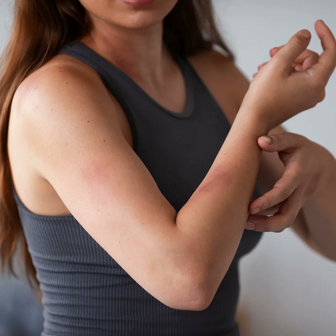 wearemmpc's tweet photo. Did you know that carpet beetle larvae can cause skin irritation, rashes, and welts? 

This is referred to as "carpet beetle dermatitis", and these skin problems are one of the signs that you might have carpet beetles in your home. https://t.co/3d6LTWNlXi