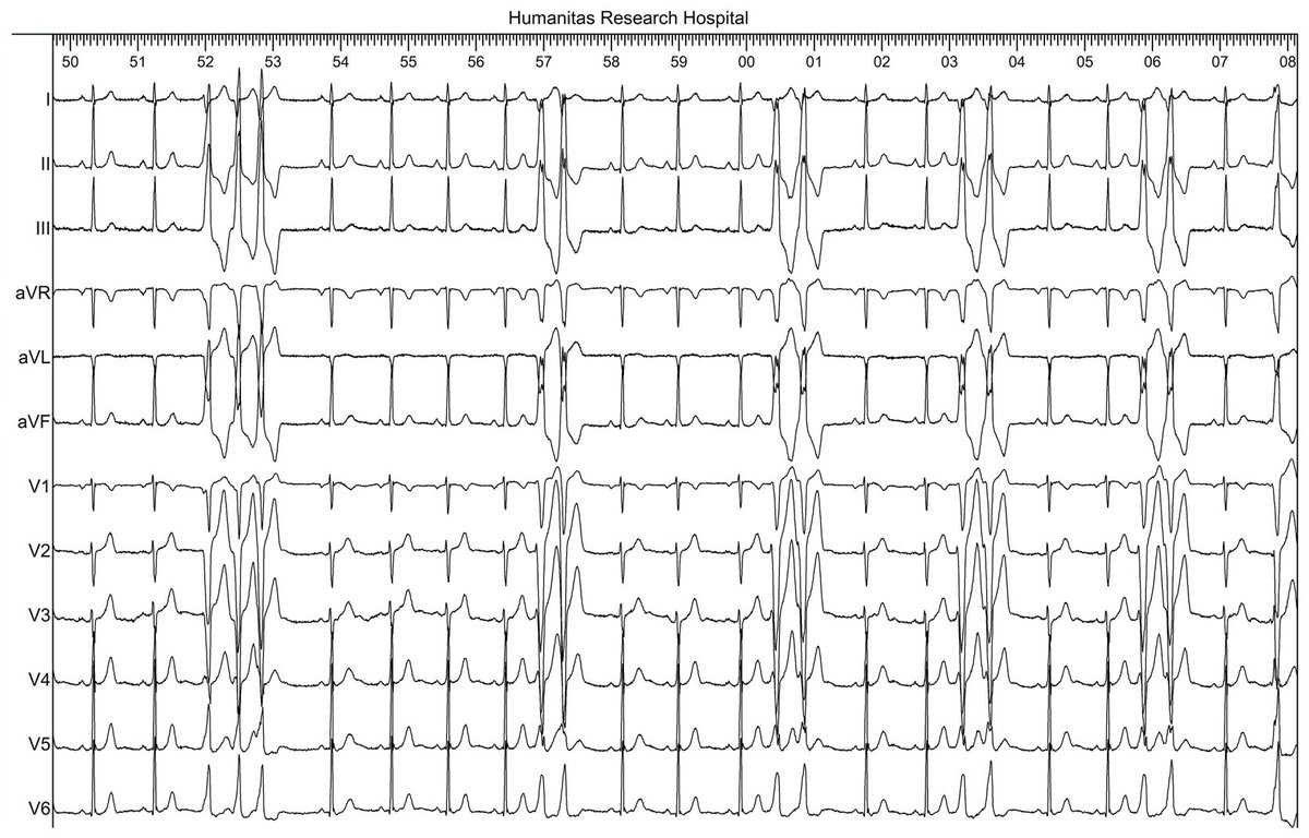 sozi81's tweet photo. 27yo girl. High burden PVCs with NSVT at the last holter 24h ECG. In these cases, purkinje potentials must be searched at the RVOT site. Precise timing of Purkinje potentials were crucial for triggering doublets or triplets. #Porn in #Electrophysiology. https://t.co/SuQxSpX7Dy
