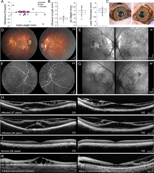 ARVOiovs's tweet photo. Glenn Yiu et al. @ucd_eyecenter @NatEyeInstitute @bcmhouston characterized a  primate model of myopic foveoschisis by clinical examination &amp; imaging followed by morphologic, cellular, and transcriptional profiling of retinal tissues and genetic analysis.
https://t.co/qSyhn0C147 https://t.co/flE4r8VgAQ