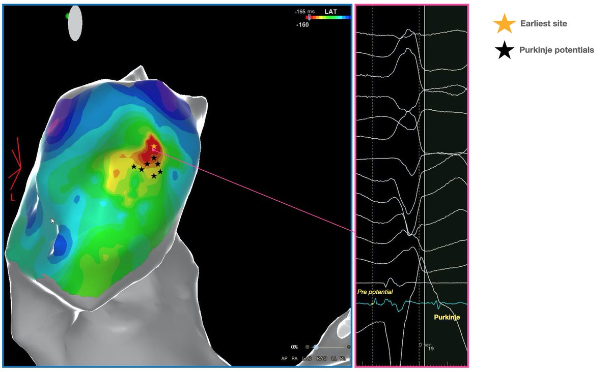 27yo girl. High burden PVCs with NSVT at the last holter 24h ECG. In these cases, purkinje potentials must be searched at the RVOT site. Precise timing of Purkinje potentials were crucial for triggering doublets or triplets. #Porn in #Electrophysiology.
