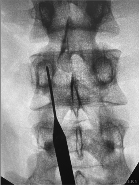 #NEUNew Percutaneous Direct Pars Repair in Young #Athletes bit.ly/3ZPfzxL by <a href="/aria_jamshidi/">Aria Jamshidi</a> <a href="/SausonSoldozy/">Sauson Soldozy, MD</a> <a href="/AllanLeviMD/">Allan Levi, MD, PhD</a> #Parsfracture #Percutaneous #Spondylolysis #Spondylolisthesis #Minimallyinvasive <a href="/JohnHShinMD/">John H. Shin MD, MBA</a> <a href="/Zaazoue/">Mohamed Zaazoue</a> <a href="/urquiagajf_MD/">Jorge F. Urquiaga</a> <a href="/CNS_Update/">CNS</a> <a href="/DKondziolkaCNS/">Douglas Kondziolka</a>