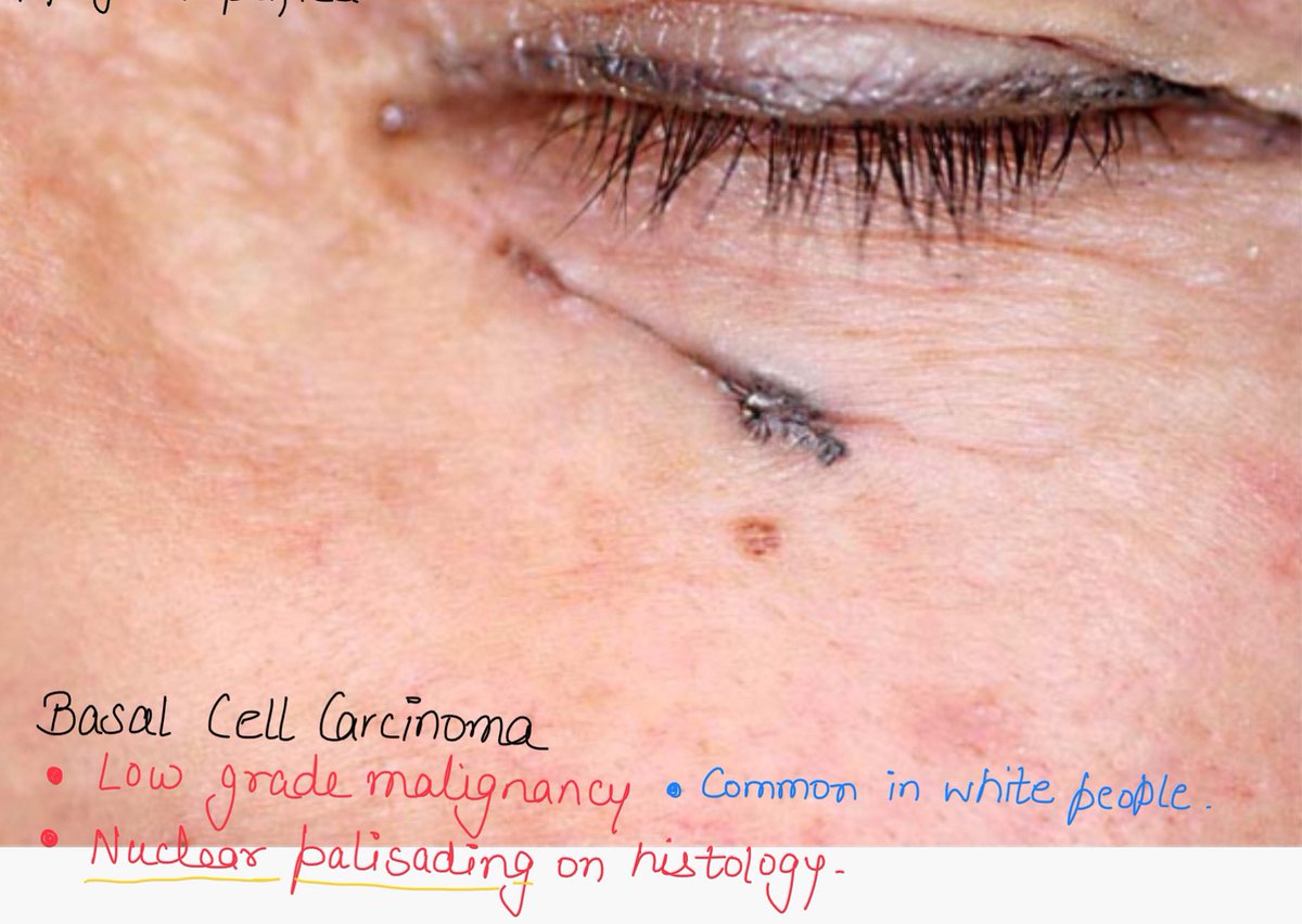 not_frustrated's tweet photo. Basal cell carcinoma👁🩺💯 https://t.co/8aIsxZt6es