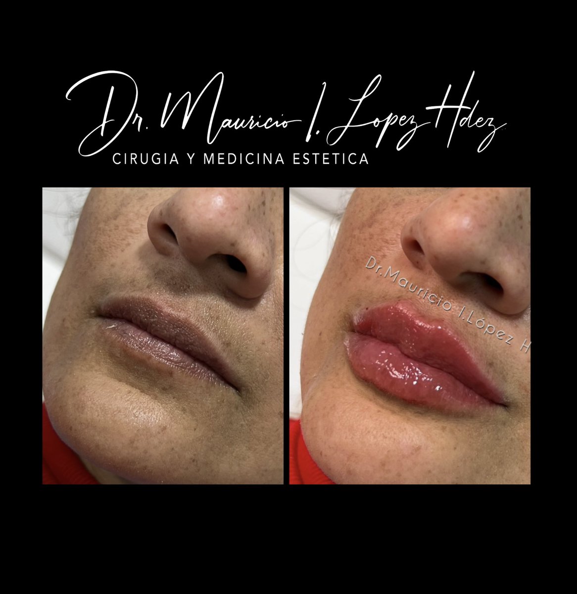 ClinSanJose's tweet photo. Diseño de Labios Personalizado con Ácido Hialuronico #lips #acidohialuronico #aesthetics #guadalajara #labios https://t.co/9tfBn2BbjV