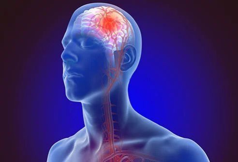 _elvis_simons's tweet photo. Initially, stroke was mostly associated with old people.

Now, both the young and the old are all prone to stroke.

Read this thread to be educated on the causes of stroke: https://t.co/btawhHewyQ