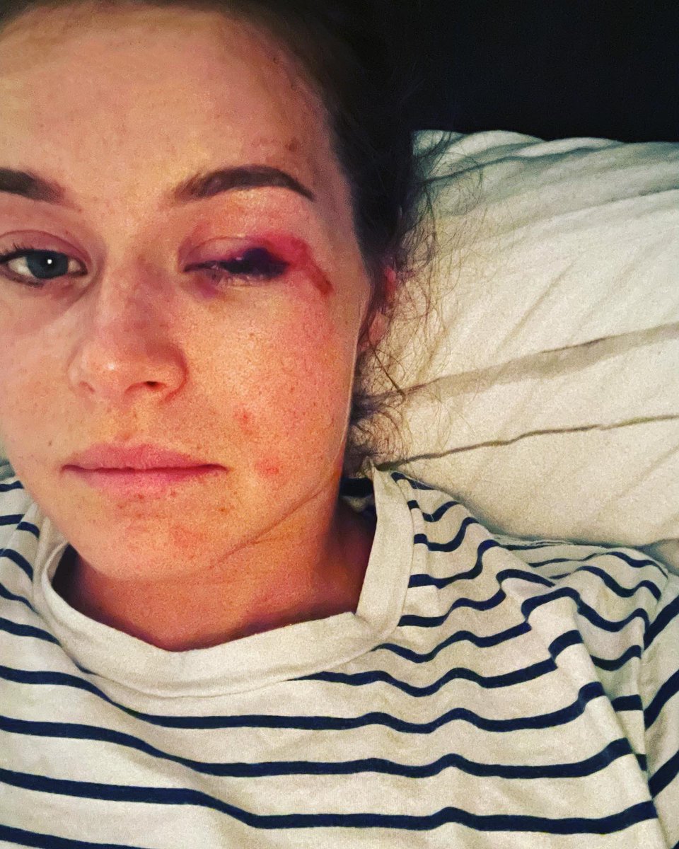 CorinneSuter's tweet photo. Well… that hurt. ❤️‍🩹
I can‘t see much for the moment but luckily my body is fine. Thank you all for the kind messages. I‘ll be back 🔜 💯! 

„The angels are nearer than you think“ ~ Billy Graham 👼 https://t.co/z78Dgf8YPh