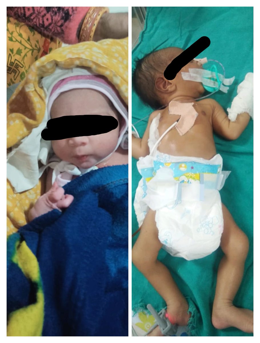 MahisagarRbsk's tweet photo. Tof child dob..18january2023
Successfully operated at Ahmedabad civil on 21-01-2023
Mahisagar
Team Mslur445
@CMOGuj @MoHFW_INDIA @MoHFW_GUJARAT https://t.co/oLni43U2mj