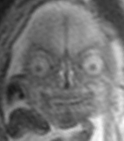 Rainmaker1973's tweet photo. An MRI of a fetus is rarely conducted for specific conditions, it costs more than routinary ultrasounds and it's a much more stressfull exam. 

Yet, the visual results are a further potential cause. 

[read more 1: https://t.co/p0gzxVXVWB]
[read more 2: https://t.co/sTmTOyJ7Ea] https://t.co/25RnkjIuWF