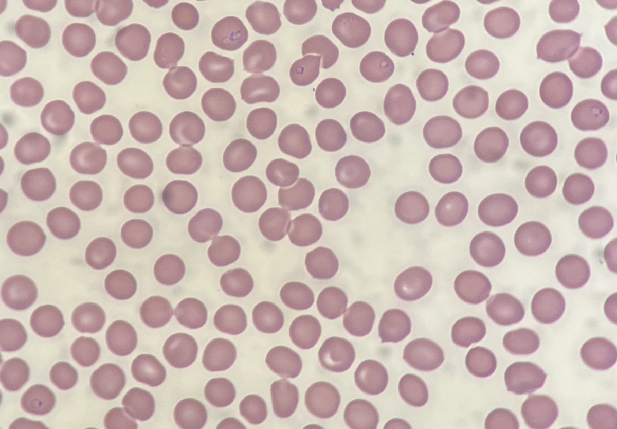 En primicia desde la guardia de hematología: 38 años, fiebre de 39,2ºC, náuseas y vómitos, recién llegado de Costa de Marfil… y este frotis