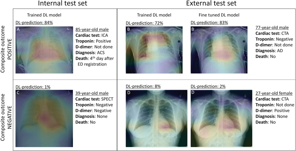 Radiology (@radiology_rsna) on Twitter photo Deep learning analysis of chest radiographs may facilitate more efficient triage of patients with acute chest pain syndrome. <a href="/MKolossvary/">Márton Kolossváry</a> <a href="/VineetRaghu2/">Vineet Raghu</a> <a href="/michael_t_lu/">Michael Lu</a> <a href="/CIRC_MGH/">MGH Cardiovascular Imaging Research Center</a> bit.ly/3IQFrDn Deep learning analysis of chest radiographs may facilitate more efficient triage of patients with acute chest pain syndrome. <a href="/MKolossvary/">Márton Kolossváry</a> <a href="/VineetRaghu2/">Vineet Raghu</a> <a href="/michael_t_lu/">Michael Lu</a> <a href="/CIRC_MGH/">MGH Cardiovascular Imaging Research Center</a> bit.ly/3IQFrDn