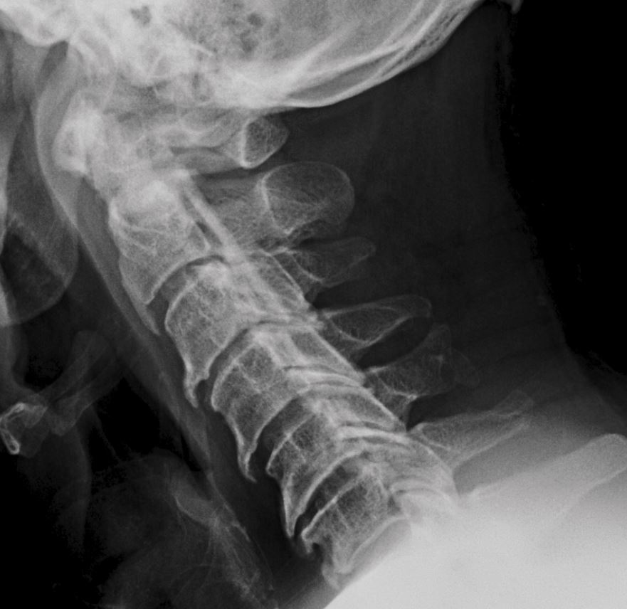 UW_MSKrad's tweet photo. #CaseOfTheWeek ‼️🎉‼️

☢️🩻☠️Case #4☠️🩻☢️brought to you again by Fellowship Director @drewrossmd !!!
 
👀Incidental finding👀

🔍🔍Thoughts? 🔍🔍

#MSKrad #MSKSpine #NeuroRad #FOAMRad #radres #MedEd #OrthoTwitter @UWRadRes https://t.co/JYBXFx7hyy