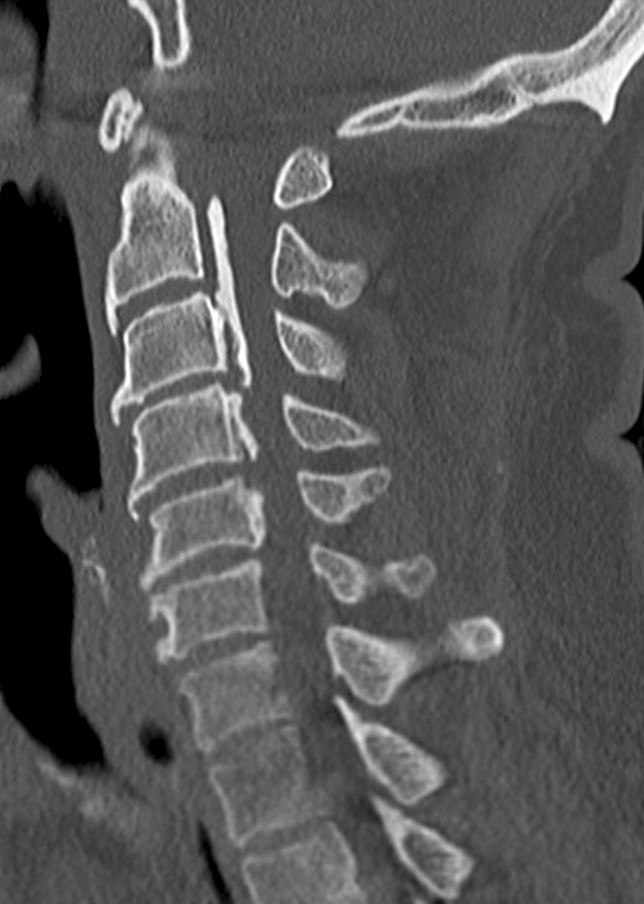 UW_MSKrad's tweet photo. #CaseOfTheWeek ‼️🎉‼️

☢️🩻☠️Case #4☠️🩻☢️brought to you again by Fellowship Director @drewrossmd !!!
 
👀Incidental finding👀

🔍🔍Thoughts? 🔍🔍

#MSKrad #MSKSpine #NeuroRad #FOAMRad #radres #MedEd #OrthoTwitter @UWRadRes https://t.co/JYBXFx7hyy