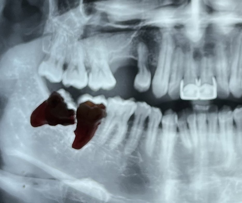 DatosDentista's tweet photo. Las complicaciones de un diente impactado:
•Absceso del diente o el área de la encía
•Molestia crónica en la boca
•Dolor al abrir y cerrar la boca
•Acumulación de placa
•Enfermedad periodontal en dientes cercanos
•Posible daño a nervio cercano https://t.co/IIGnS4zndL